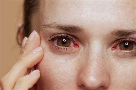 Eye Allergies: Most Common Reasons For Itchy Red Eyes | Allergy ...