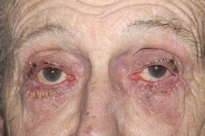 Allergic reaction to glaucoma eye drops - Stock Image - M155/0607 ...