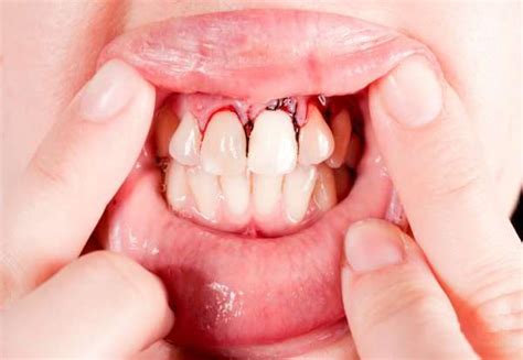 Chipped Tooth | Greenlife Dental