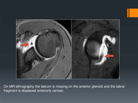 Shoulder labral tears MRI