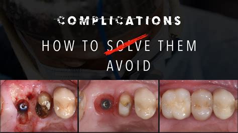 Complications in Implant Dentistry. How to solve them and how to avoid ...