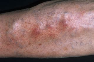 Phlebitis (superficial thrombophlebitis) - NHS