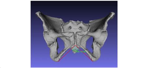 Pelvic image showing subpubic angle measurement using the MeshLab and ...