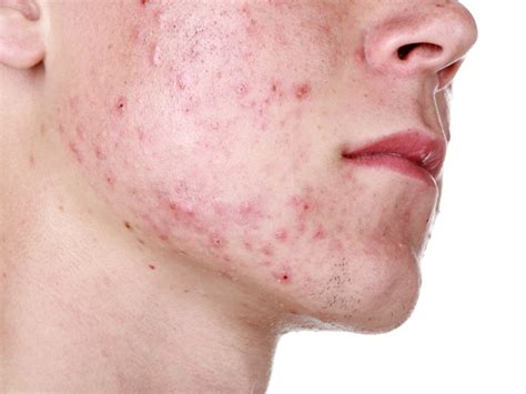 What is Cystic Acne and Why is it Caused? | Styles At Life