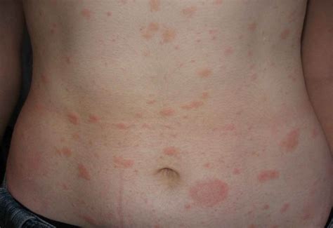 Early symptoms of psoriasis pictures | Symptoms and pictures