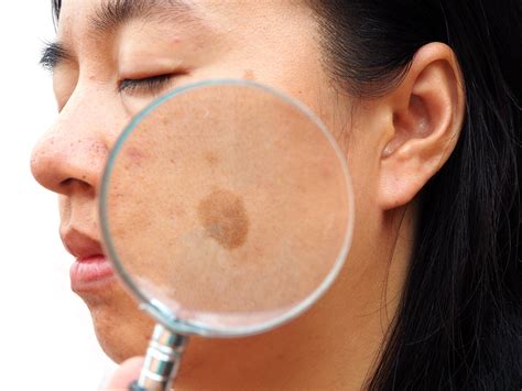 Melasma treatment possibilities expand thanks to new research