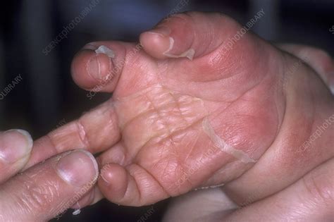 Staphylococcal scalded skin syndrome - Stock Image - C051/0099 ...