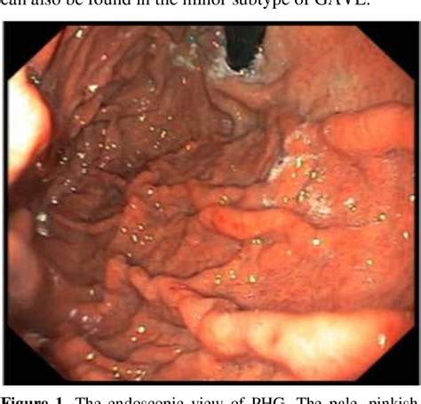 Figure 1 from Comparison of portal hypertensive gastropathy and gastric antral vascular ectasia ...