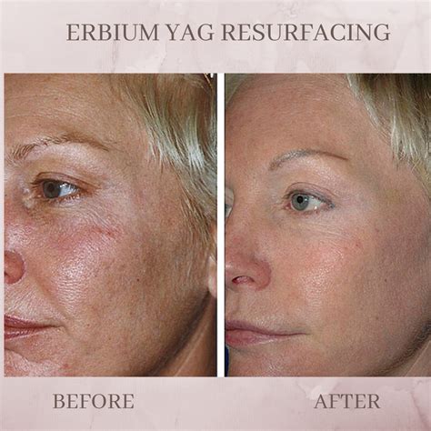 Erbium Skin Resurfacing - Eluma - Laser & Aesthetics