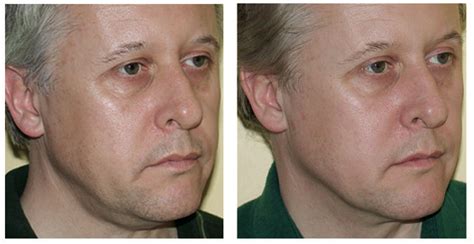 Thermage Eyes Before And After Photos - Infoupdate.org