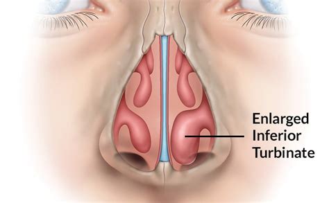 Turbinate Hypertrophy | SINUS INSTITUTE