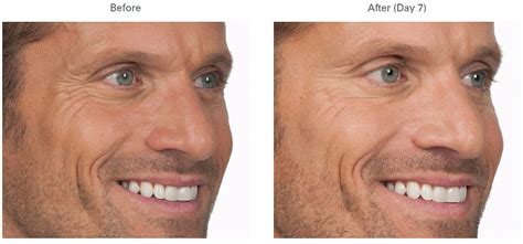 Botox for Men | Forehead, Crow's Feet, Lines Between Eyes — Spa 35