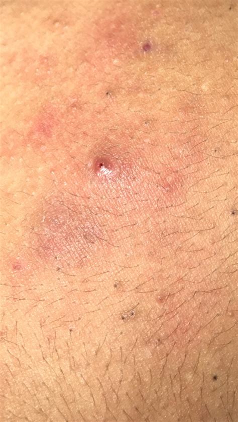 What type of acne is this on my chest . Painful! : r/acne