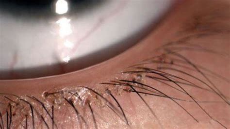 Child has eyelashes removed after doctors find 20 lice