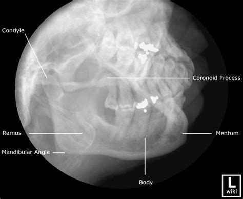 Pin on Radiographic Anatomy