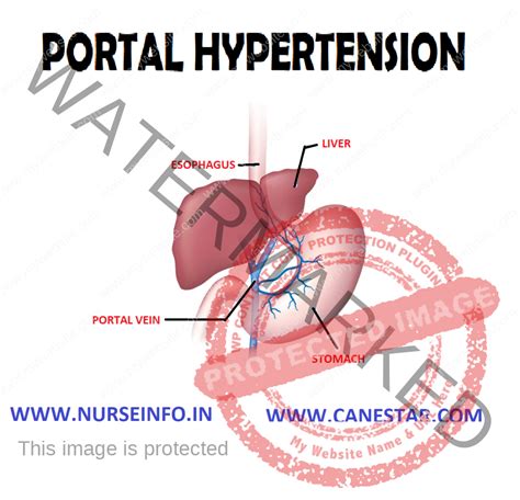 PORTAL HYPERTENSION - Nurse Info