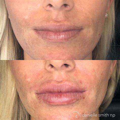 Lip augmentation with Juvederm Danielle Smith NP injected 2 syringes of Juvederm Ultra Plus over ...