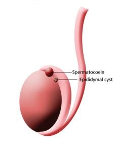 Spermatocele - Causes, Symptoms, Treatment and Pictures