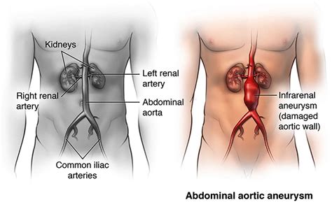 Abdominal Aortic Aneuysm | SFVVG
