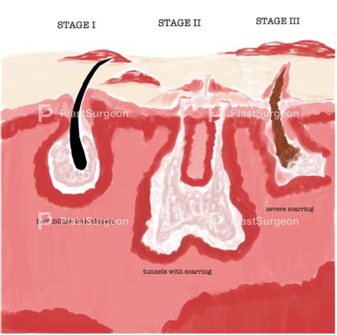 Introduction to Hidradenitis Suppurativa – PlastSurgeon