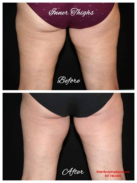 CoolSculpting Before & After Photos - Riverside Medical S.C