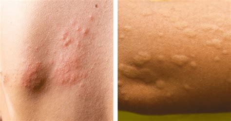 Cold Urticaria: Symptoms And Treatment