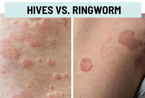 Hives (Urticaria) vs. Rash: Pictures and Differences