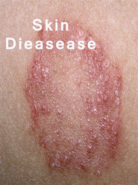 10 Most Common Skin Diseases
