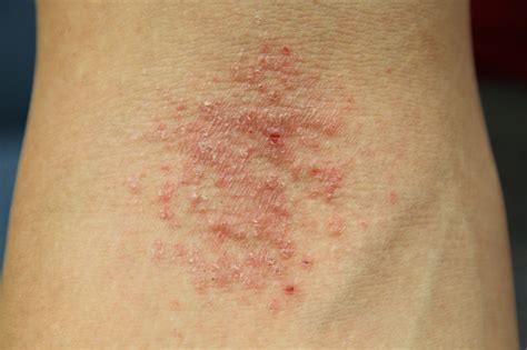 Eczema Bumps On Arms