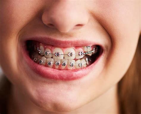 How To Take Care For Metal Braces In Hindi | how to take care for metal braces | HerZindagi