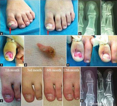 Clinical photograph showing (a) protruded subungual exostosis (arrow)... | Download Scientific ...