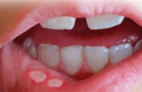 Research Dispels Myths About Recurrent Aphthous Stomatitis - Dentistry Today