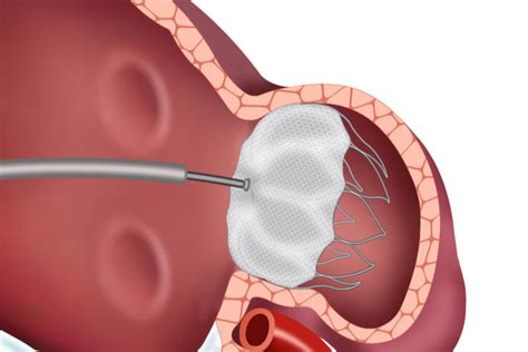 Bettering Coronary heart Sufferers’ Lives with Left Atrial Appendage ...