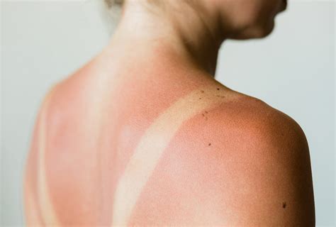 Sunburn: Symptoms, Risk Factors, and Treatment Options