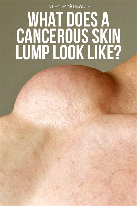 What Does a Cancerous Skin Lump Look Like? | Skin, Epidermoid cyst ...