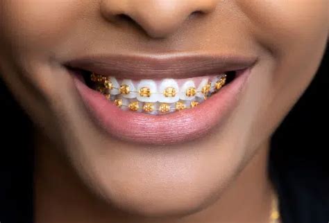 Gold Braces for Teeth: Gold Vibes Only at Augusta Orthodontics