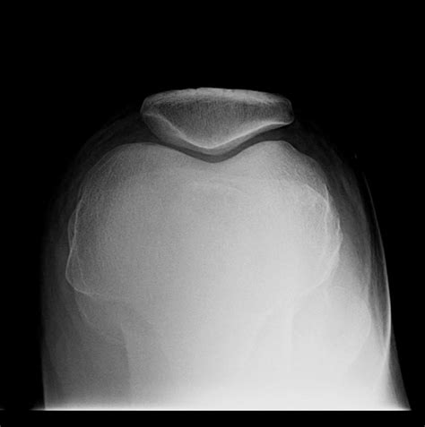 PATELLA SUNRISE X RAY | buyxraysonline