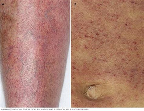 Idiopathic Thrombocytopenic Purpura