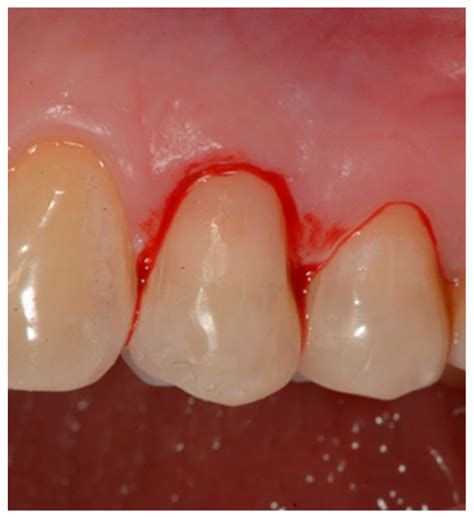 Dentistry Journal | Free Full-Text | Clinical Behavior of the Gingival Margin following ...