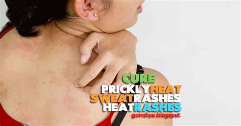 26 Natural Home Remedies for Prickly Heat, Sweat Rashes, Heat Rashes, Sunburn - Part 2 - Natural ...