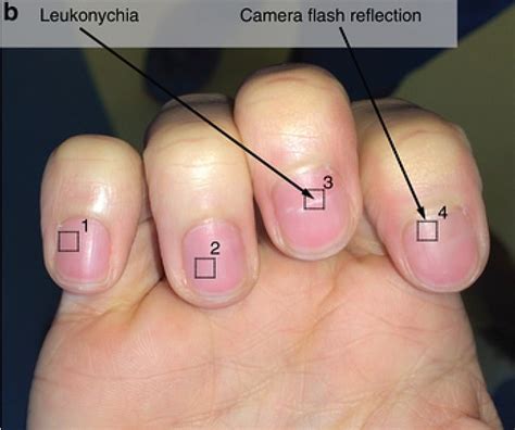 Iron Deficiency Fingernails at Charles Oyler blog