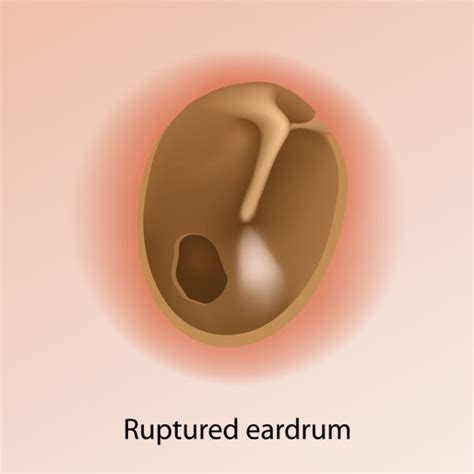 Perforated Tympanic Membrane Treatment