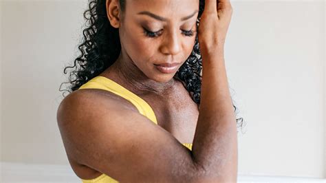 Eczema on Black Skin: Pictures, Symptoms, and Treatment