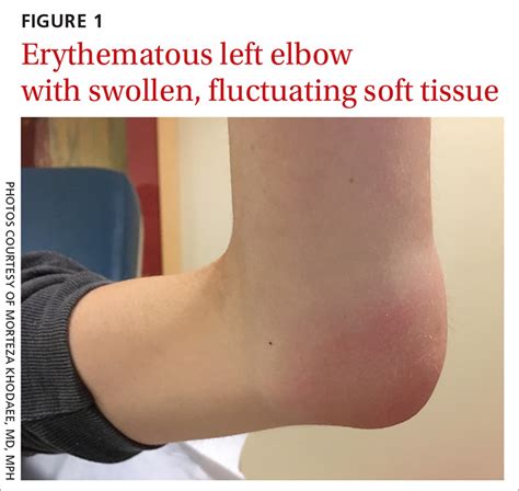 Lump On Elbow Joint