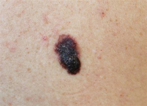 Mit jelent az első stádiumú melanoma?