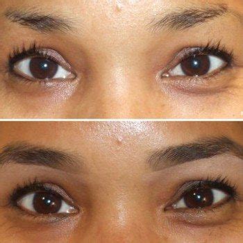 Does Minoxidil Work For Eyebrows - EyebrowShaper