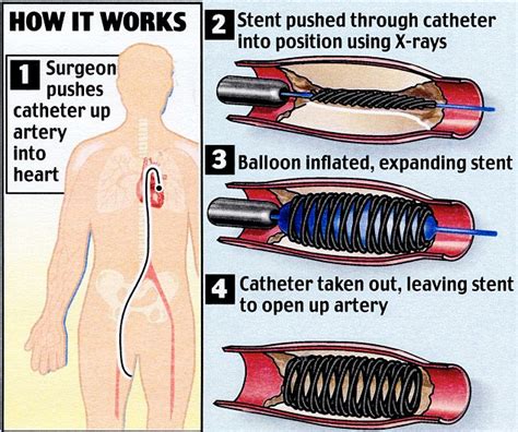 Duke of Edinburgh taken to hospital with chest pains and treated for a blocked coronary artery ...