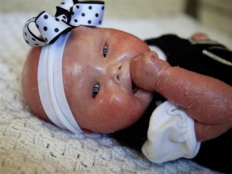 Meet Brenna, a baby with Harlequin Ichthyosis - Photo 3 - Pictures - CBS News