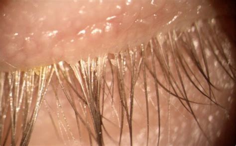 Demodex Eyelash Mites