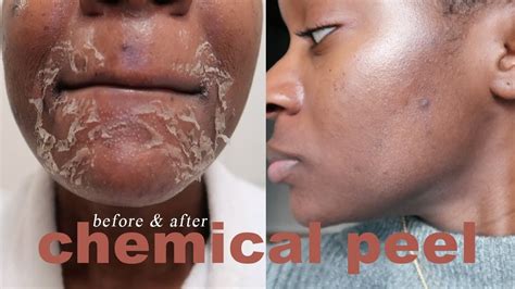 Chemical Peel Acne Scars | atelier-yuwa.ciao.jp